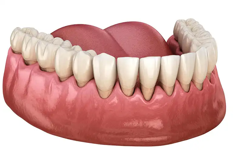 Receding gums is one of the symptoms of periodontitis.