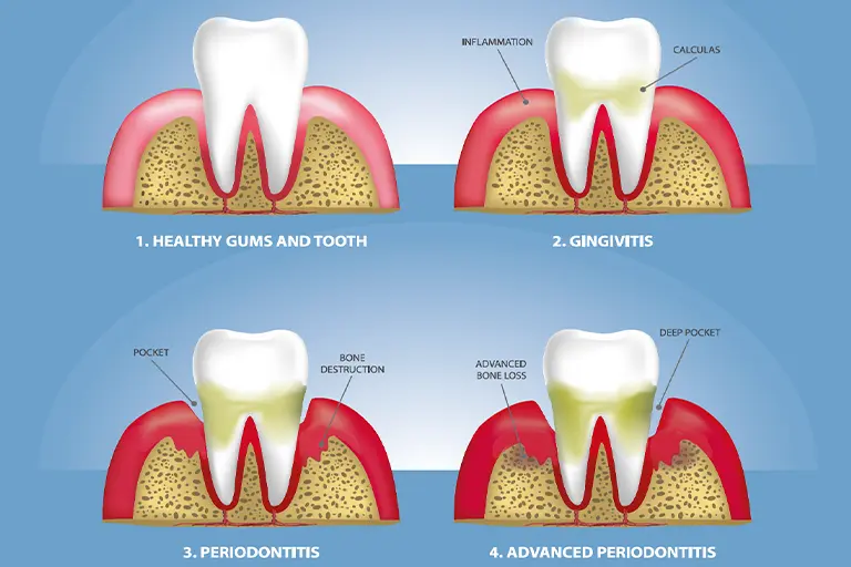 stages of gum disease (periodontitis)