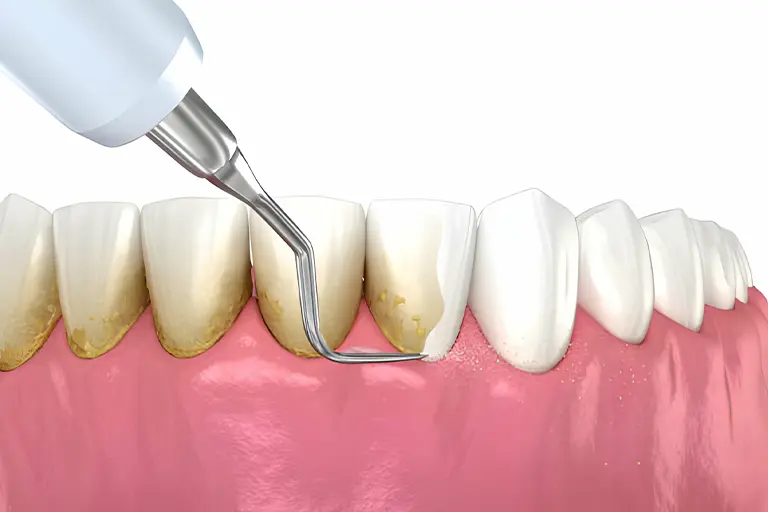 Teeth scaling procedure