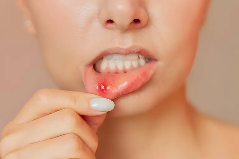 oral mucocele lip treatment